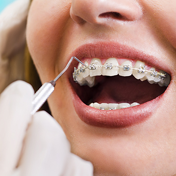 fastbraces image