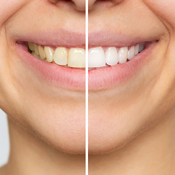 teeth-whitening image