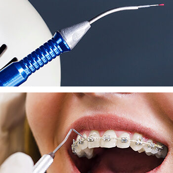 Fastbraces & Laser Dentistry